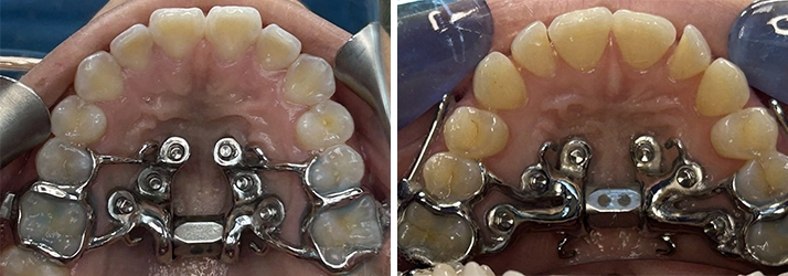 Orthodontist Greeley CO MARPE Device MARPE Device