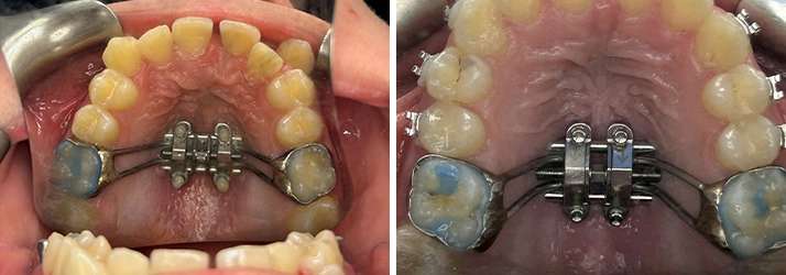 ORHTO – MSE (Maxillary Skeletal Expander) in Greeley CO ORHTO – MSE (Maxillary Skeletal Expander) in Greeley CO